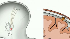 Neuralink Brain Chip