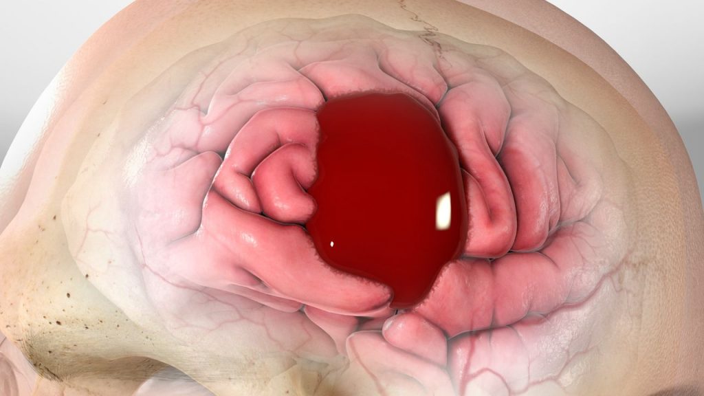 Chronic Subdural Hematoma