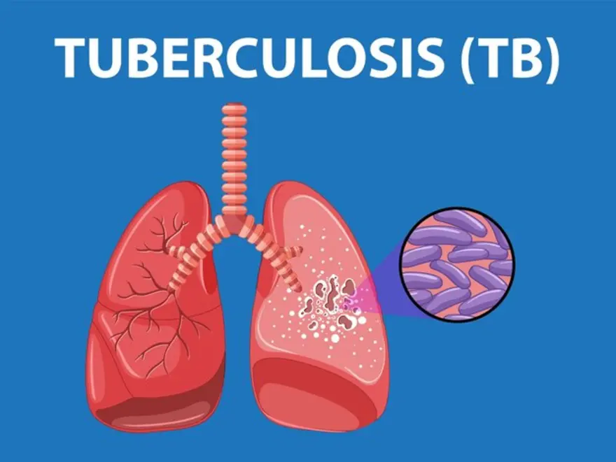 World Tuberculosis Day 2024