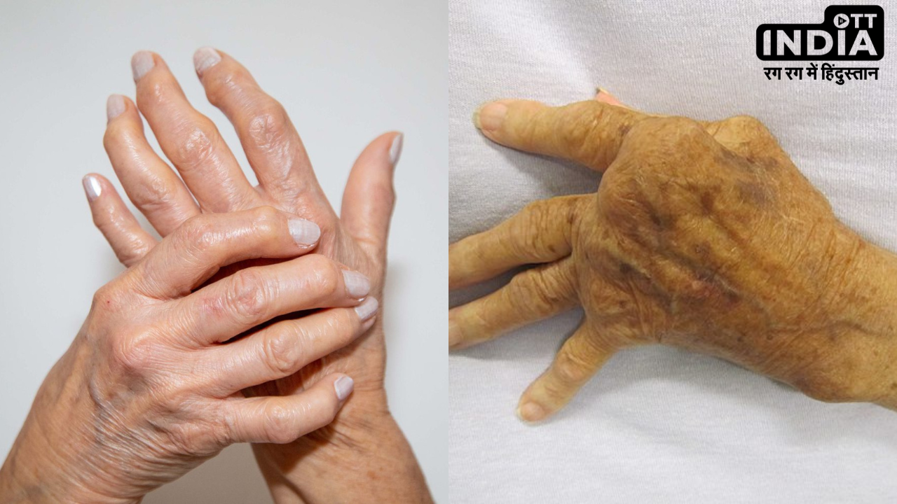 Rheumatoid arthritis: हड्डी की समस्या डैमेज कर सकती है आँखों की रौशनी, जानिये कैसे करें बचाव