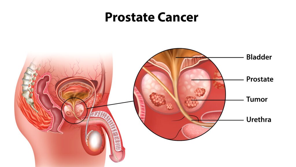 Lancet Study on Prostate Cancer