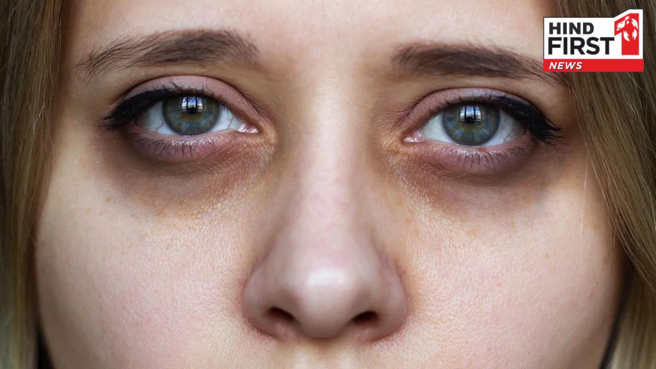 Dark Circles Under Eyes: इन हेल्थ प्रॉब्लम्स से होती है आंखों के नीचे काले घेरों की समस्या, ऐसे करें ठीक