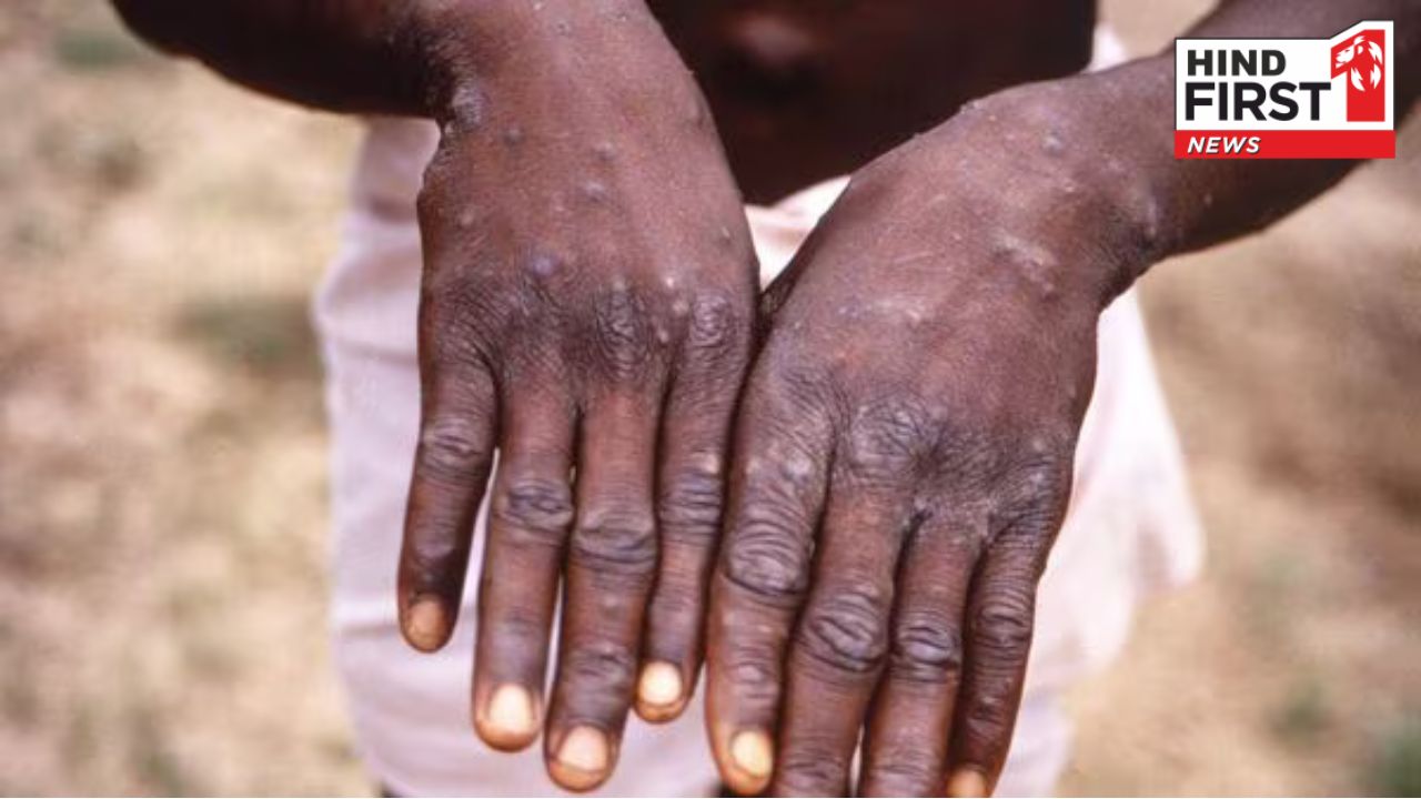 Monkeypox: क्या है मंकीपॉक्स जिसको लेकर WHO ने जारी की है चेतावनी? जानिये इसके कारण, लक्षण और उपचार